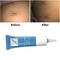 Universal Silicone Scar Remover Removal Serum Face Skin Burns Repair U2R1