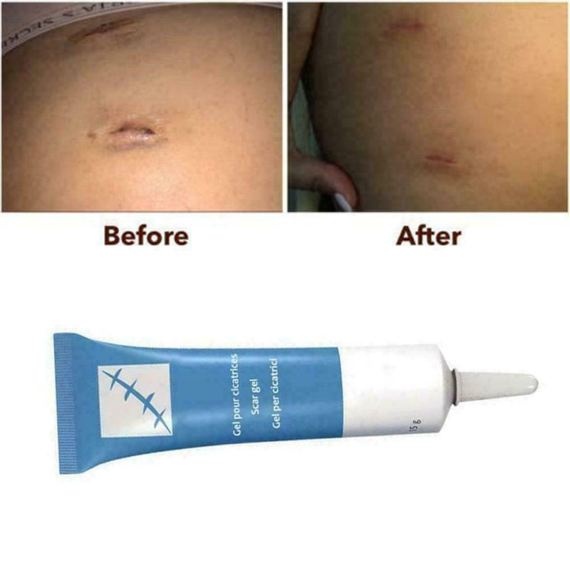 Universal Silicone Scar Remover Removal Serum Face Skin Burns Repair U2R1
