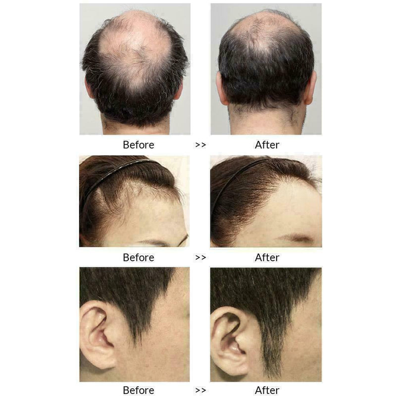 Anti Hair Loss Hair Growth Spray Essential Liquid Dry Regeneration Repair H G7A3