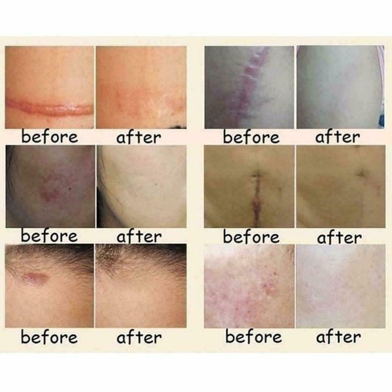 Lavender Essence Skin Care Natural Pure Remove Ance Mark Burn Strentch Remo H0D9