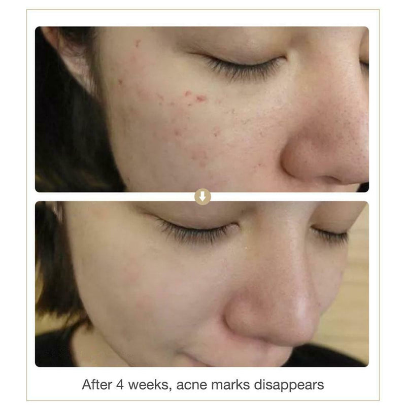 Face Repair Powder Oligopeptide Lyophilized Solution Acne Blood Caps Pore Shrink