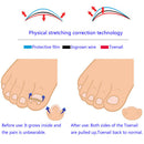 12pcs toenail correction tool ingrown wire fixer toe nail recover foot M&E