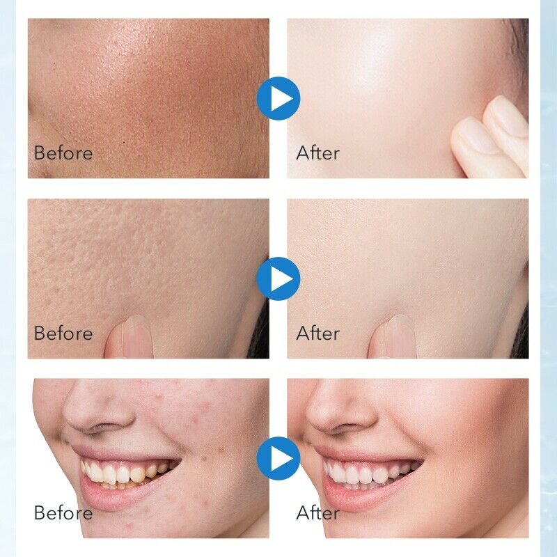 Daralis Face Exfoliating Mousse Shrink Pores Removal Blackhead Skin Care Fo Y8E4