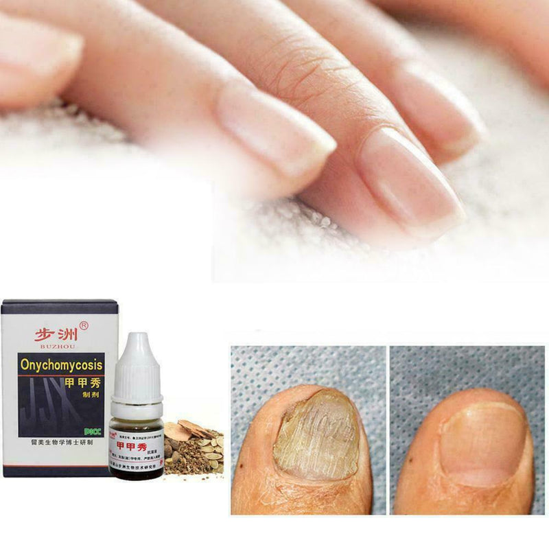 Footcare Oil 15ml Gehwol Nail Softner Fluid Ingrown Nails Callus Toe Z2L1