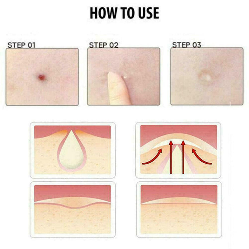 24x Skin Tag & Acne Patch - New Hydrocolloid Acne And Skin Tag Remover Patc C0U4