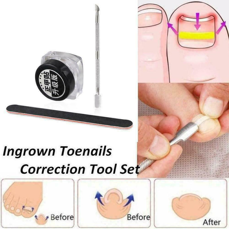 Ingrown Toenail Straightening Clip Glue Correction Curved Hot Brace Kit P3Y8
