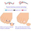 12pcs toenail correction tool ingrown wire fixer toe nail recover foot  TwJ Gw