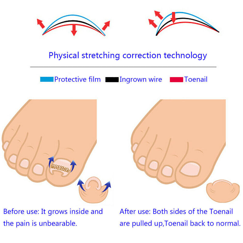 12pcs toenail correction tool ingrown wire fixer toe nail recover foot  TwJ Gw