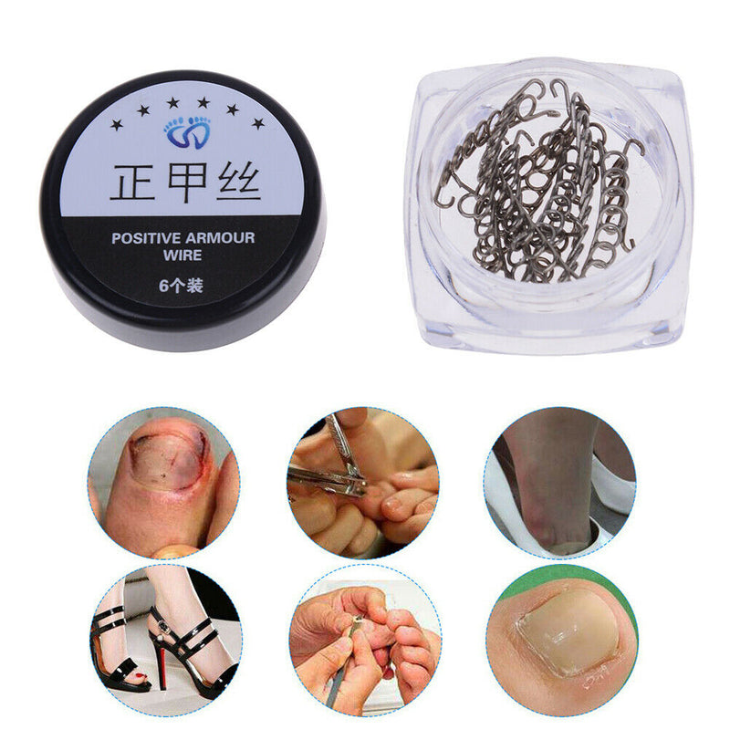 12pcs toenail correction tool ingrown wire fixer toe nail recover foot  TwJ Gw