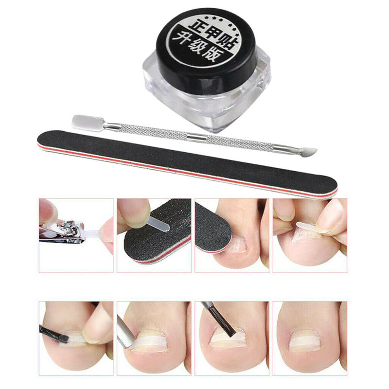 Ingrown Toenail Corrector Patch Brace Treatment Tape w/Pusher Nail File Set