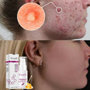 RtopR Propolis Repair Acne Brightening Serum Acne Scar Spots Cleaning Serum K9M4
