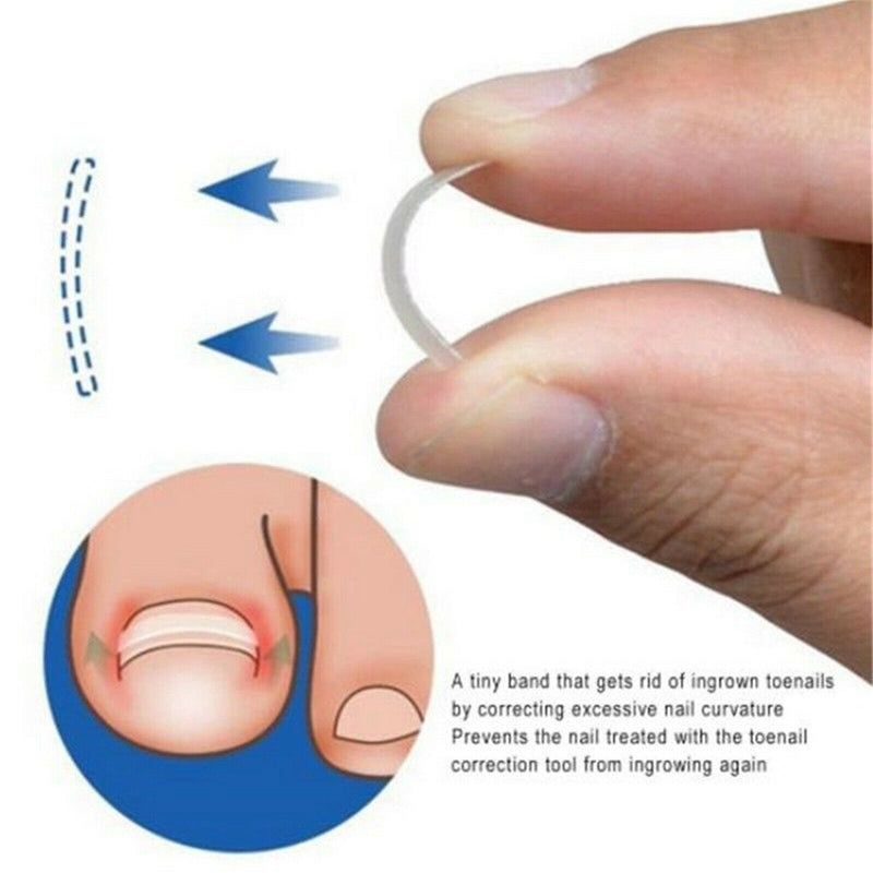 Ingrown Toe Nail Straightening Clip Brace Foot Care Toe Nail Correction Tool