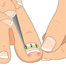 Ingrown Toenail Pedicure Tool 10Pcs/Bottle Straightening Clip Curved Bs Bra D8Q1