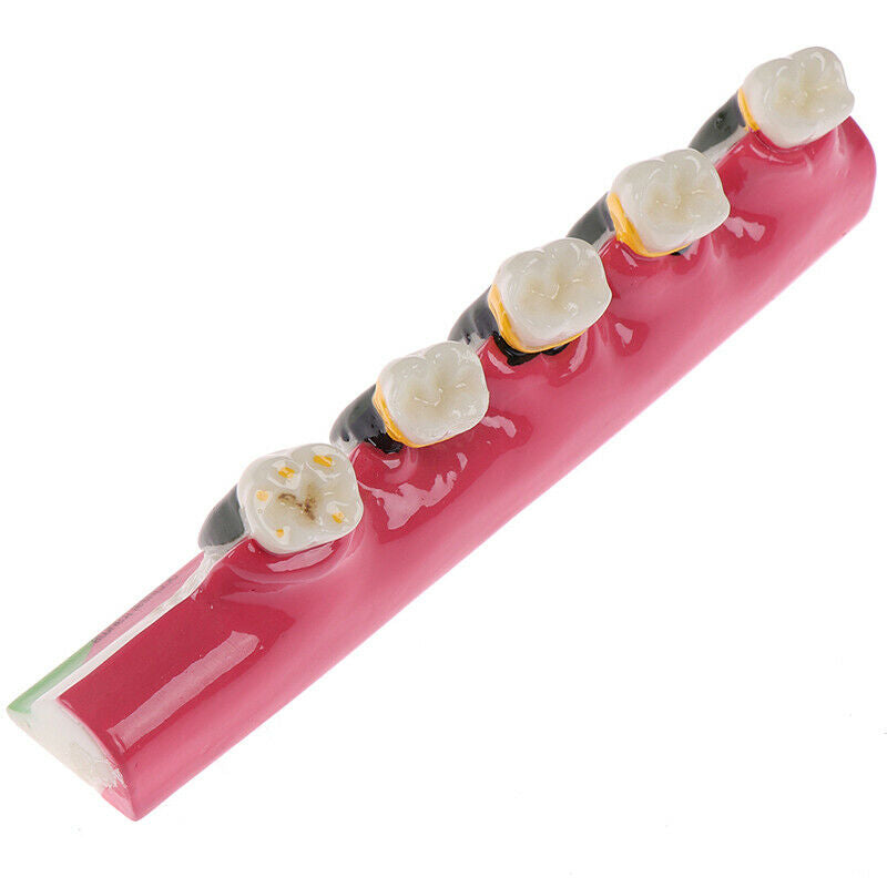 Dental Lab Periodontal Disease Assort Tooth Typodont Study Teaching Teeth ModFT