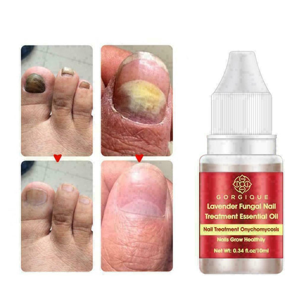 Nail Treatment Essential Oil Nail Nourishing Brightening Promote Nails Foot Y2J3