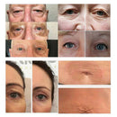 8Pcs/Set Replace Needles Mole Removal Plasma Pen Freckle Dark Spot Remover S Ew