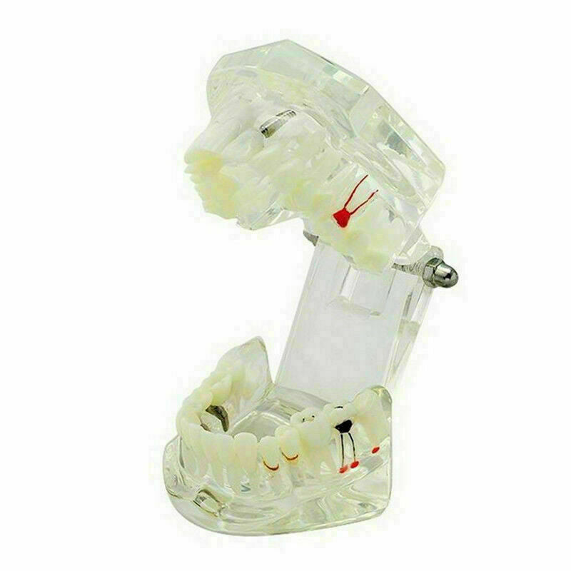 Teeth Restoration Implant Removable Disease Tooth & Teaching Dental Bridge A2X0