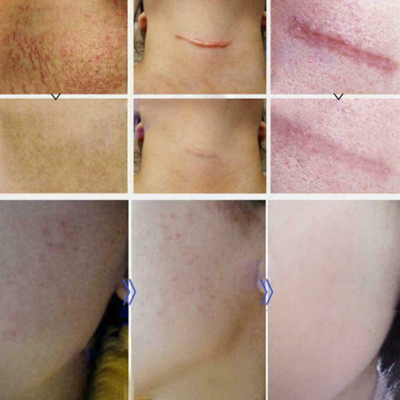 Lavender Essence Skin Care Natural Pure Remove Ance Mark Burn Strentch Remo H0D9