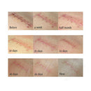 Artiscare Scar Acne Mark Removing Gel Tcm Blackhead Treatment Whitening Ski R7L9