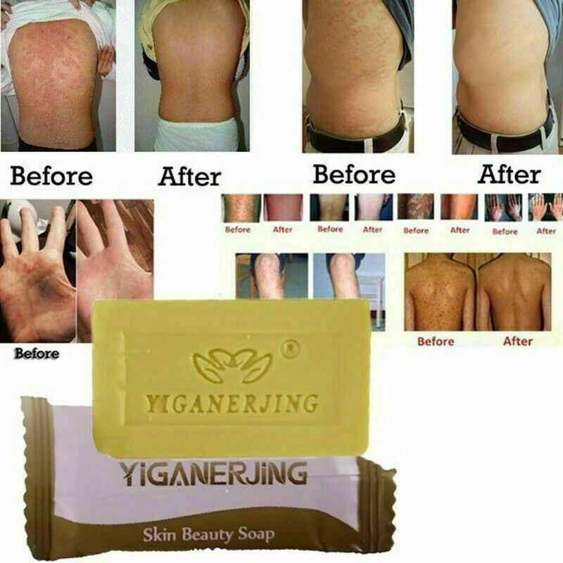 Natural Sulfur Acne Anti Fungus Bath Shower Soap Health Care Hotel Bathroom New