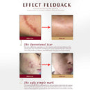 Artiscare Scar Acne Mark Removing Gel Tcm Blackhead Treatment Whitening Ski R7L9