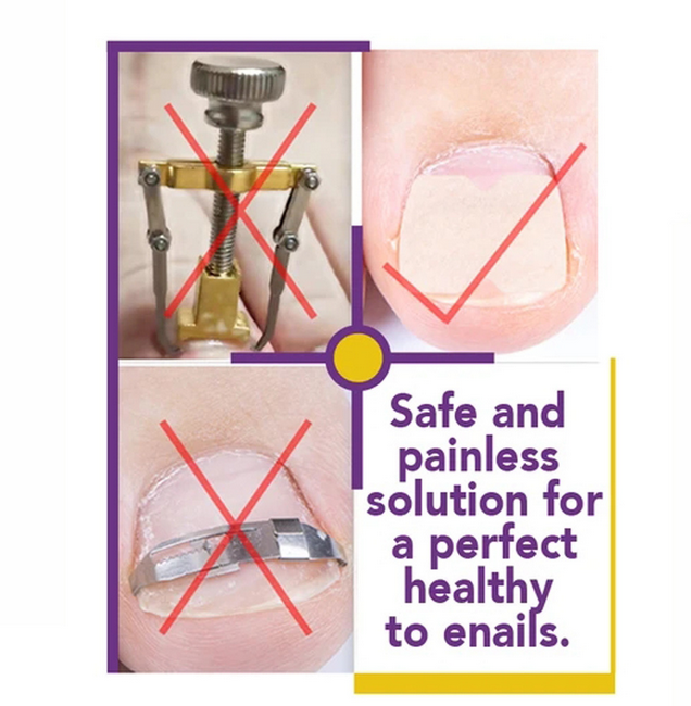 50 sheets Non-Glue Toenail Patch Ingrown Toenail Correction Pedicure Tools