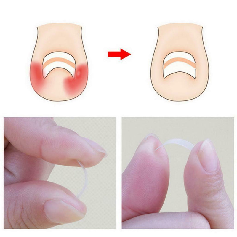 Lots 10 Ingrown Toenail Straightening Clip Toe Nails Correction Elastic Patches