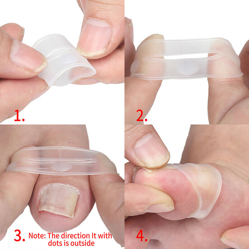 Silicone Ingrown Toenail Correction Tool Invisible Ingrown Toe Nail Treatmen Cy