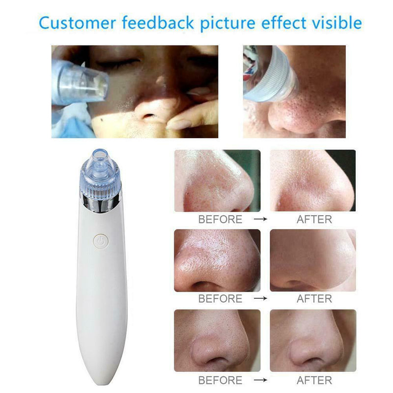 Facial Acne Blackhead Remover Vacuum Suction Pore Clean Machine (White C) SN9F