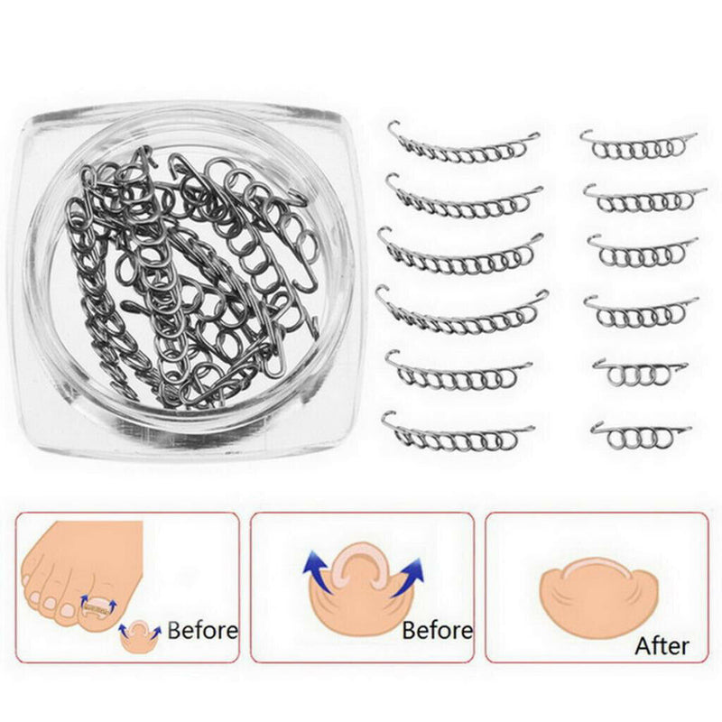 Toenail Correction Tool,12 pcs/set Ingrown Toe Nail Fixer Pedicure Toenail