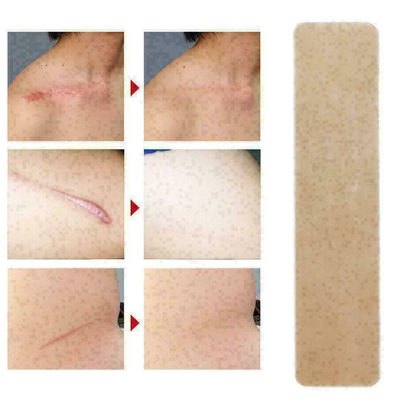 New Medical Scar Away Patch Silicone Gel Sheet Wound Treatmen Removal R0R3 Z2U3