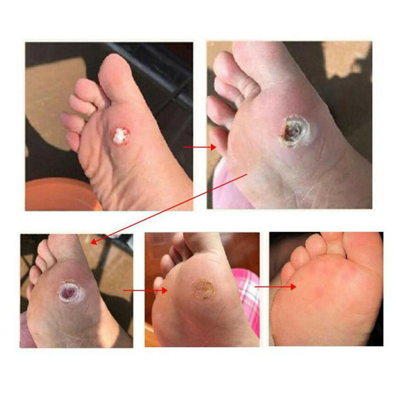 Skin Tag Removal, All Natural, Home Skin Care, Remove Skin Tag Efficiently, Best