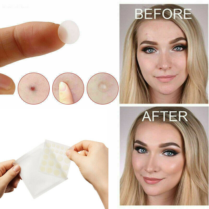 36Pcs Skin Tag & Acne Patch - NEW Hydrocolloid Acne & Skin Tag Remover Patches