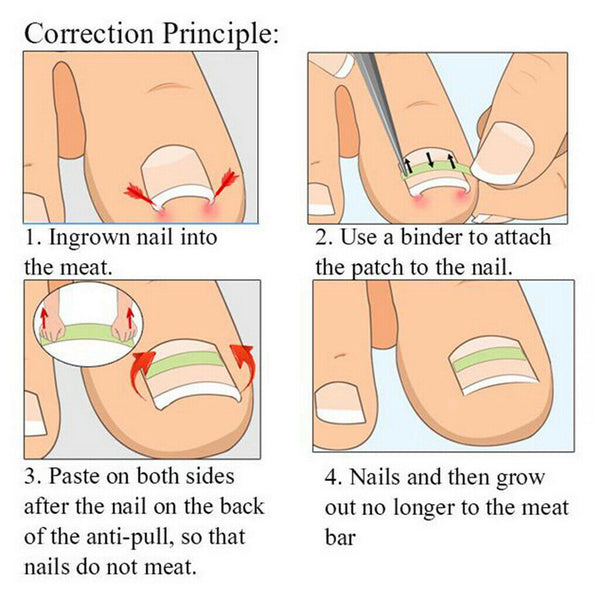 10Pcs Ingrown Onyxis Toe Nail Correction Recover Pedicure Orthotic Tool