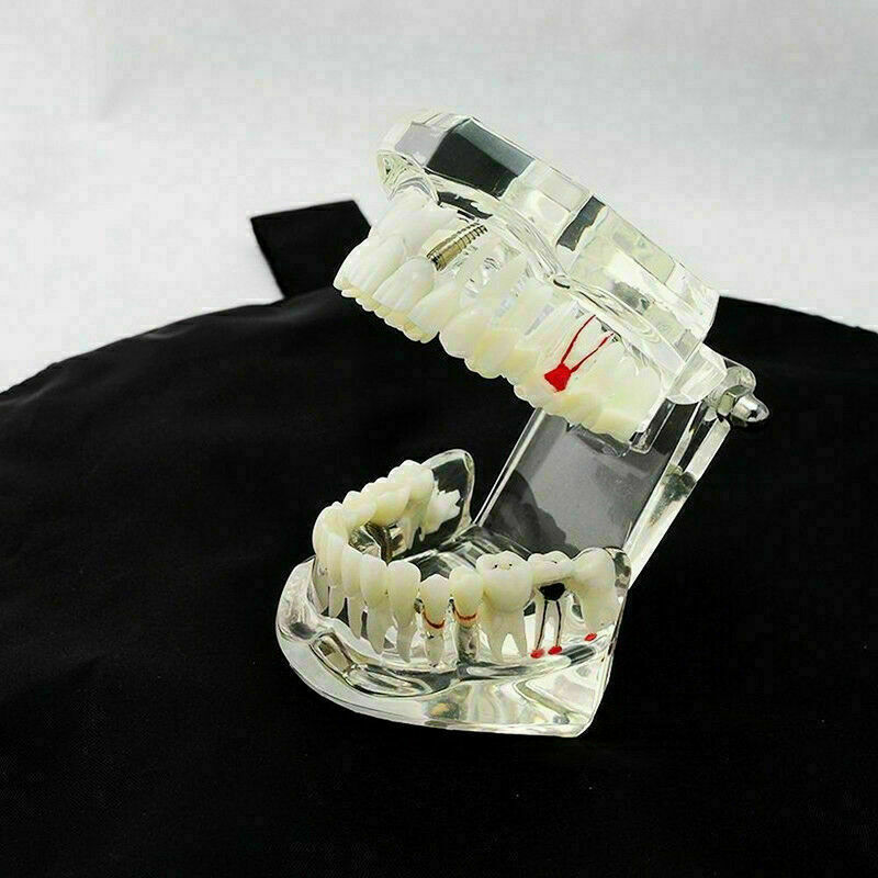 Teeth Restoration Implant Removable Disease Tooth & Teaching Dental Bridge A2X0