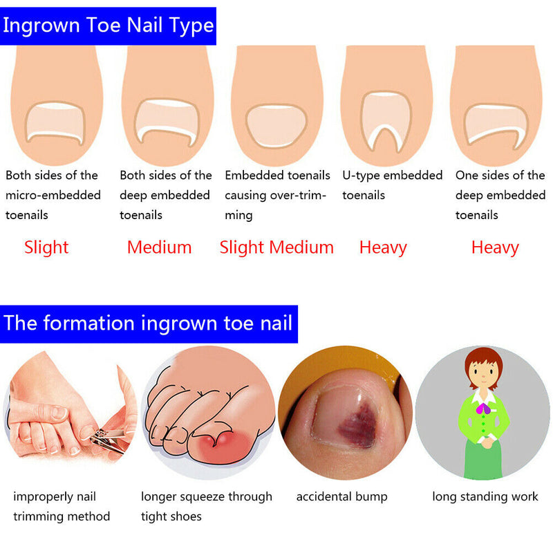 12pcs toenail correction tool ingrown wire fixer toe nail recover foot  TwJ Gw