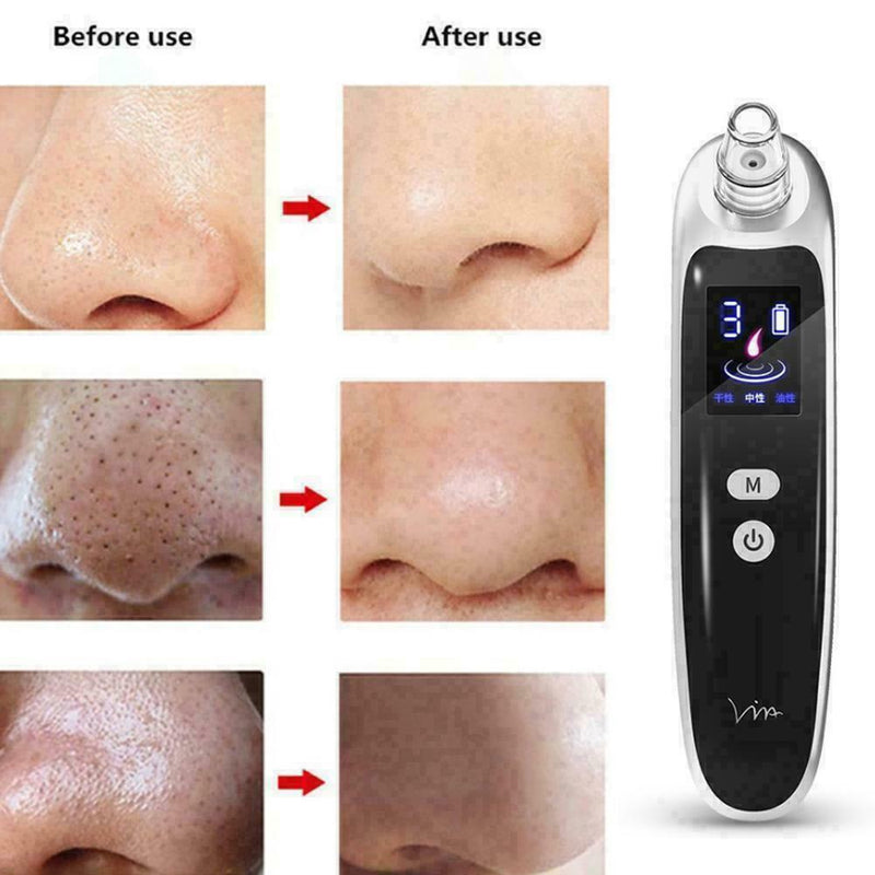Electric Acne Blackhead Vacuum Cleaner Skin Care Tool Nose Clean Face Pores I0B8