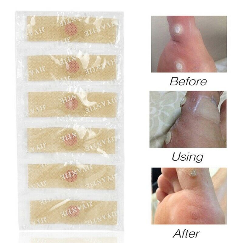 42Pcs Medical Plasters Foot Corn Removal Warts Thorn Patch Curative Patches T6J8