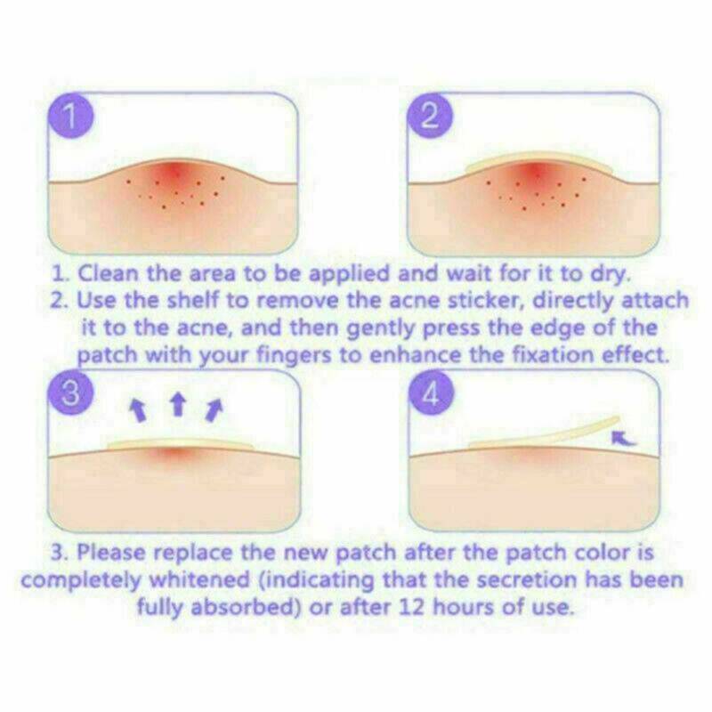 Pack of 36Pcs Invisible Acne Patch Anti Pimple Stickers Spot Scar Care Treatment
