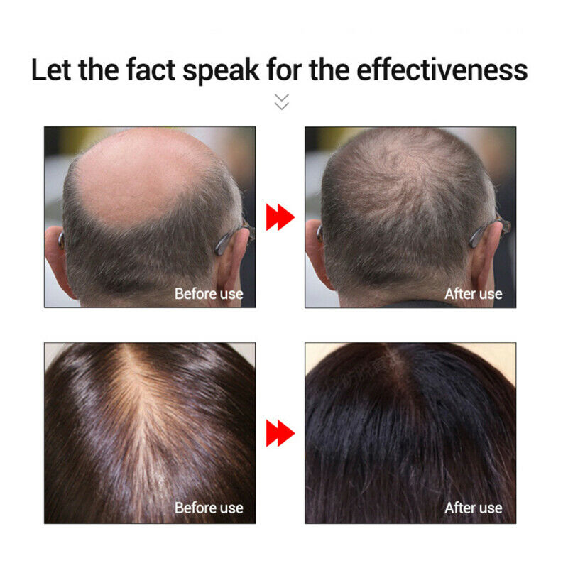 20ml Fast Powerful Hair Growth Care Essential Oil Liquid Hair Loss Treatme QMJ