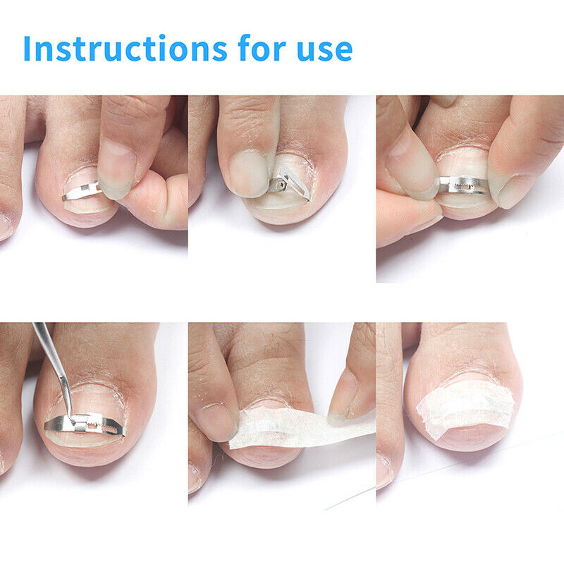 Ingrown Toe Nail Recover Correction Patch Pedicure Toenail Fixer Foot Care T Pg