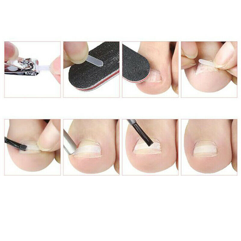 3Pcs Nail Pedicure Elastic Patch Clip Brace Bunion Ingrown Toenail Correct a1 Gw