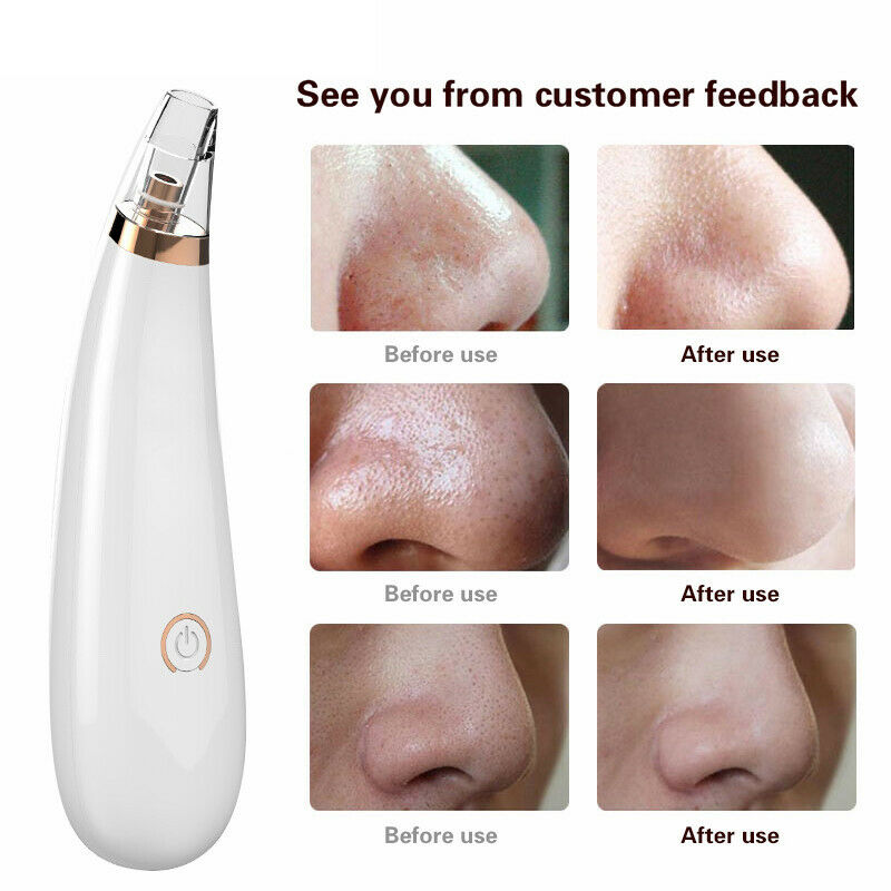 Face Nose Acne Blackhead Removal Blackhead Vacuum Cleaner Pores Blackhead S T1I8