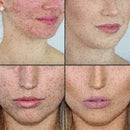 10ml 100 Tree Pure Essential Oil Face Care Skin Acne Treatment Oil High T7S7