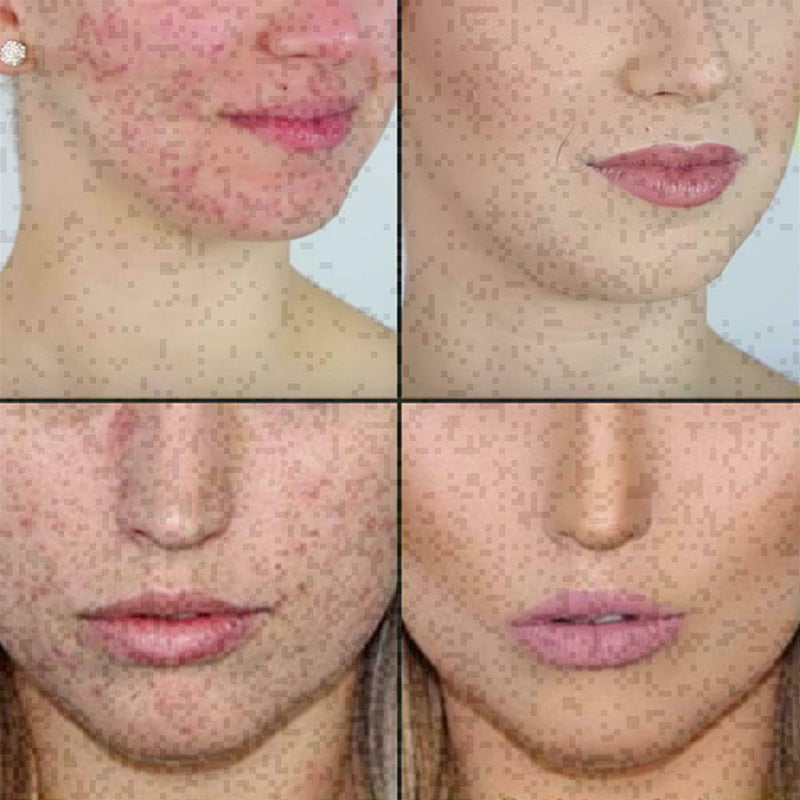 10ml 100 Tree Pure Essential Oil Face Care Skin Acne Treatment Oil High T7S7