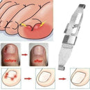 Ingrown Toe Nail Correction Pedicure Straightener Clippers Recover B3M0