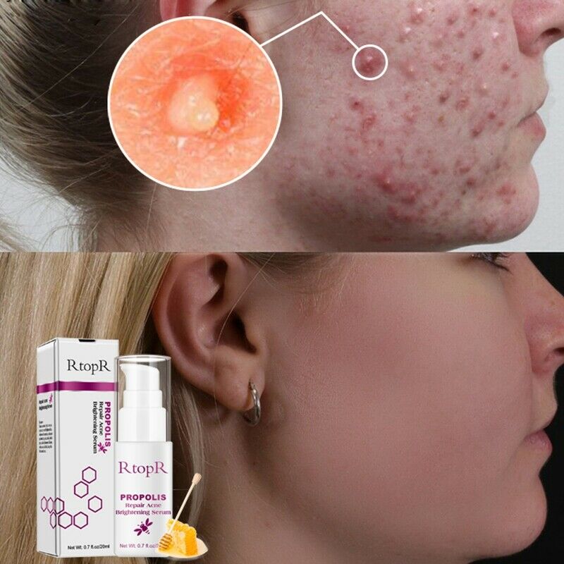RtopR Propolis Repair Acne Brightening Serum Acne Scar Spots Cleaning Serum U2P3