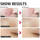 5PCS Blackhead Remover Cleaner Acne Cleanser Needle Tool P1C8 Y9N5 P S G1B0