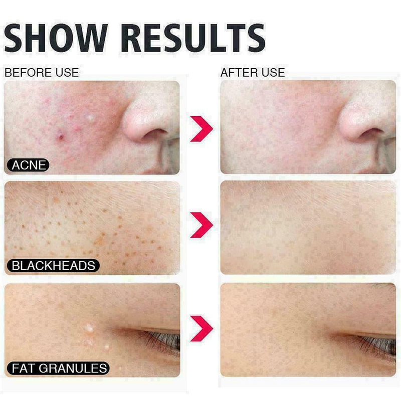 5PCS Blackhead Remover Cleaner Acne Cleanser Needle Tool P1C8 Y9N5 P S G1B0