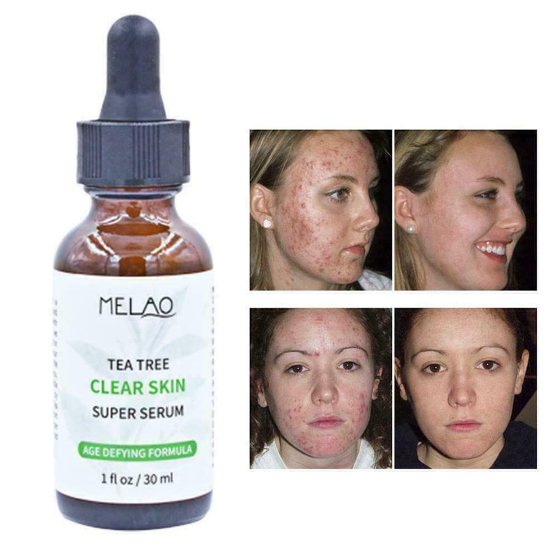 Pure Natural Tree Essential Oil Acne Treatment Face Z Skin Care Z1R9